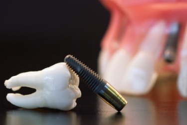 Cấy ghép răng implant như thế nào ?