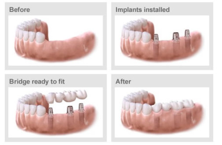 Implant áp dụng cho tất cả trường hợp mất răng được không?