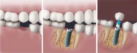 Implant áp dụng cho tất cả trường hợp mất răng được không?