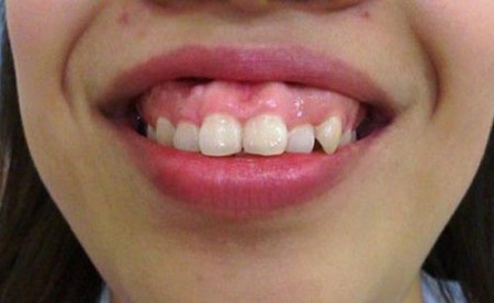 Làm gì để sở hữu hàm răng thẳng đều hoàn hảo?