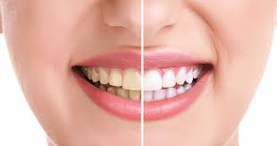 Tẩy trắng răng có an toàn không?