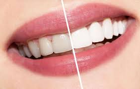 Tẩy trắng răng có an toàn không?