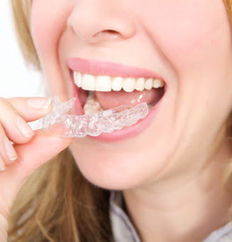 Ưu điểm của giải pháp niềng răng không mắc cài 4