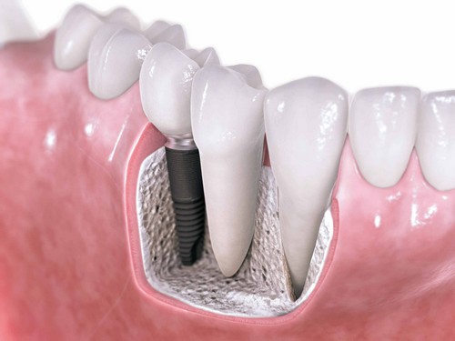 Những trường hợp được và không được trồng răng implant