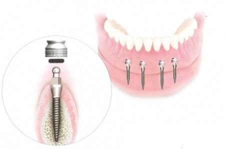 Có nên sử dụng mini implant để trồng răng 