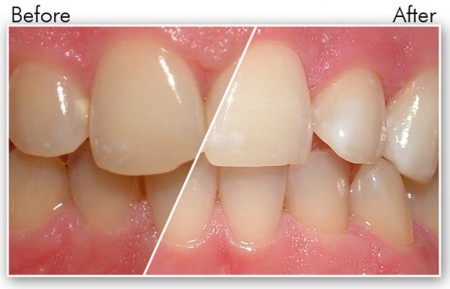Các bước tẩy trắng răng bằng công nghệ Halogen 2