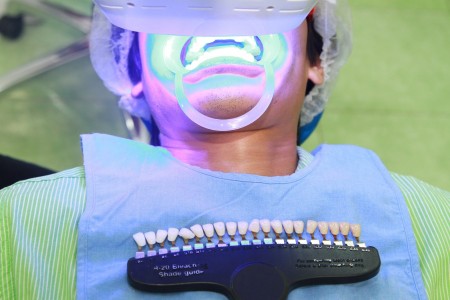 Các bước tẩy trắng răng bằng công nghệ Halogen 1