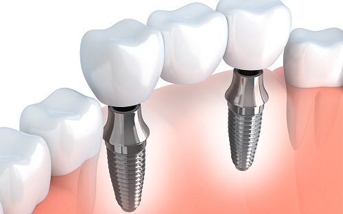 Những gì được thực hiện trong quá trình cấy ghép implant
