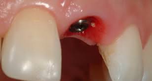 Chăm sóc răng miệng sau khi cấy ghép implant
