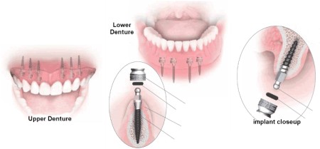 Chăm sóc răng miệng sau khi cấy ghép implant