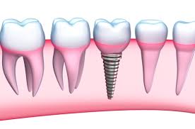 trồng răng implant ở đâu tốt tại tphcm