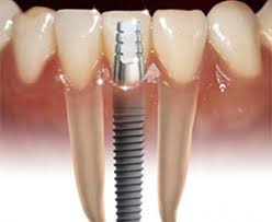 trồng răng implant ở đâu tốt tại tphcm