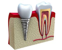 trồng răng implant ở đâu tốt tại tphcm