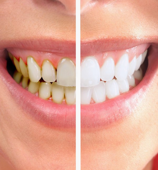 Tẩy trắng răng có chi phí bao nhiêu ? 1