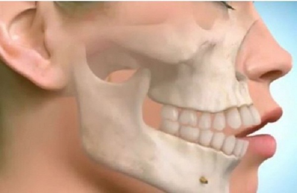 phẫu thuật hàm hô có đau không