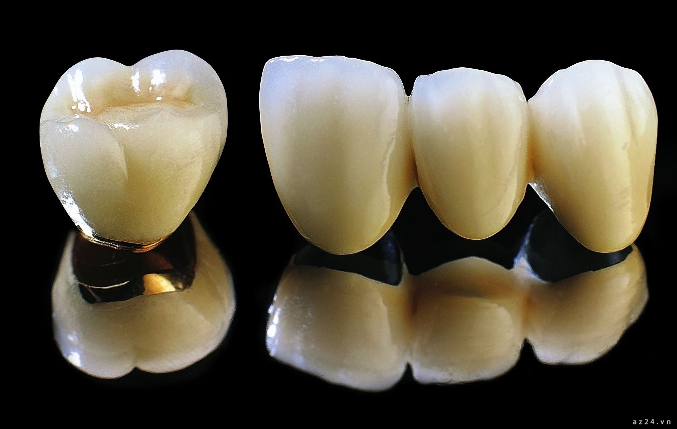 Răng sứ cercon và răng sứ titan có bền không? 3