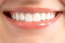 răng sứ veneer là gì