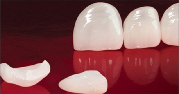 răng sứ veneer là gì