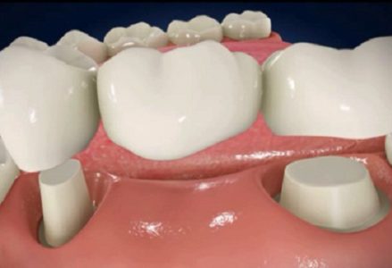 trồng răng sứ thẩm mỹ