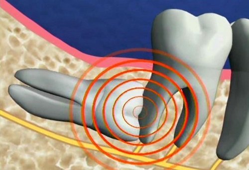 Chi phí nhổ răng khôn bao nhiêu tiền?