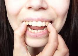 Áp dụng phương pháp niềng răng có hết hô không? 