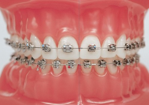 Niềng răng mắc cài 3m ugsl công nghệ mới hiệu quả cao 1