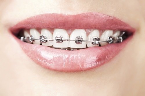 Niềng răng mắc cài 3m ugsl công nghệ mới hiệu quả cao 2