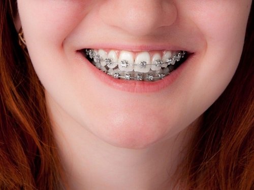 Niềng răng mắc cài 3m ugsl công nghệ mới hiệu quả cao 3