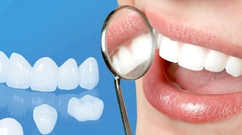 Bọc răng sứ xong có niềng được không? 1