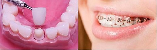 Bọc răng sứ xong có niềng được không? 2