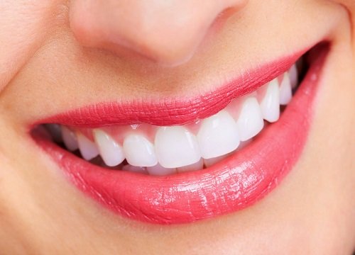 Bọc răng sứ xong có niềng được không? 3