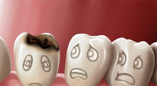 Răng sứ có bị sâu không? Kiến thức chuyên sâu về răng sứ 1