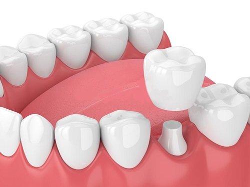 Răng sứ có bị sâu không? Kiến thức chuyên sâu về răng sứ 2
