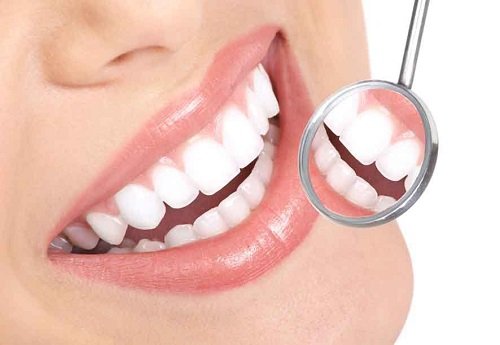 Răng sứ có bị sâu không? Kiến thức chuyên sâu về răng sứ 3