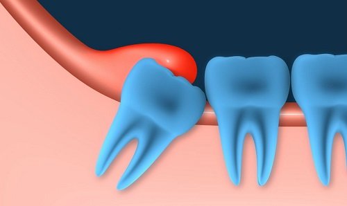 Điều trị viêm lợi trùm răng khôn hiệu quả tại nhà