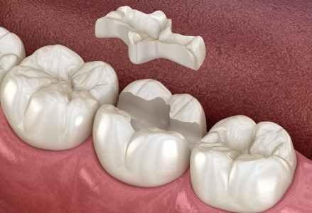 Quy trình trám răng sâu chuẩn nhất hiện nay