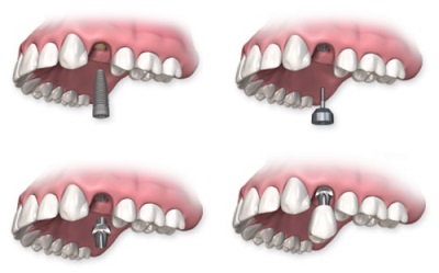 mô phỏng kỹ thuật cấy ghép răng implant