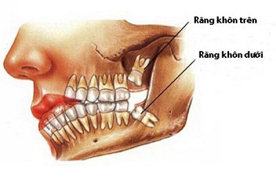 Răng khôn có phải răng số 8 không ?